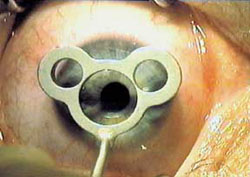 Probst "Smiley" LASIK Marker